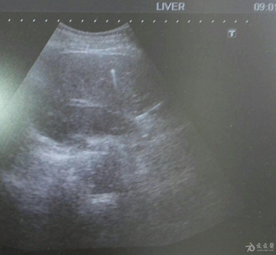 请老师帮忙看看:肝脏点状强回声伴慧星尾征,是肝内胆管积气还是钙化灶