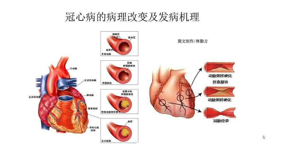 冠心病圖片