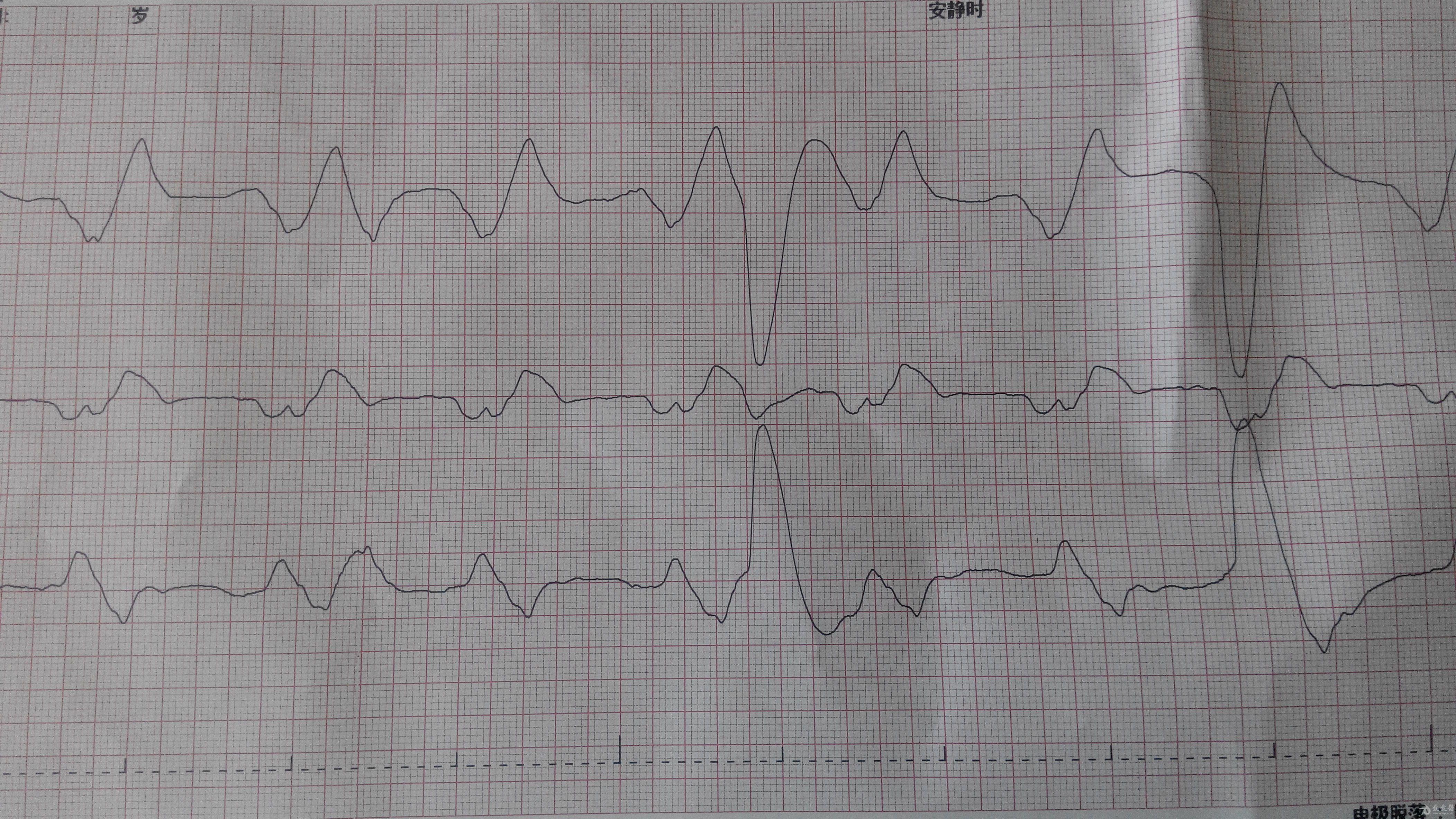 新生儿抢救心电图