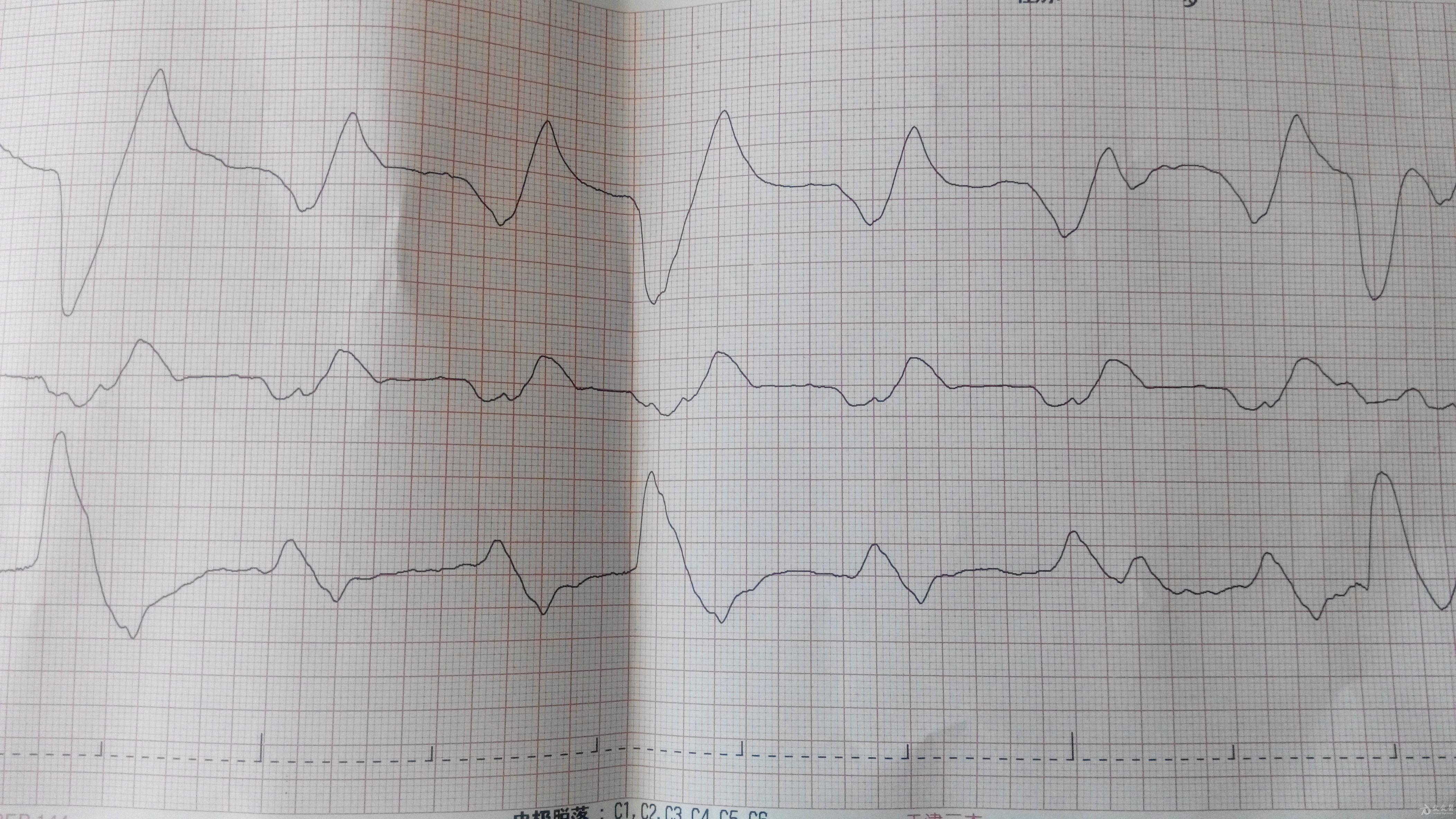 新生儿抢救心电图