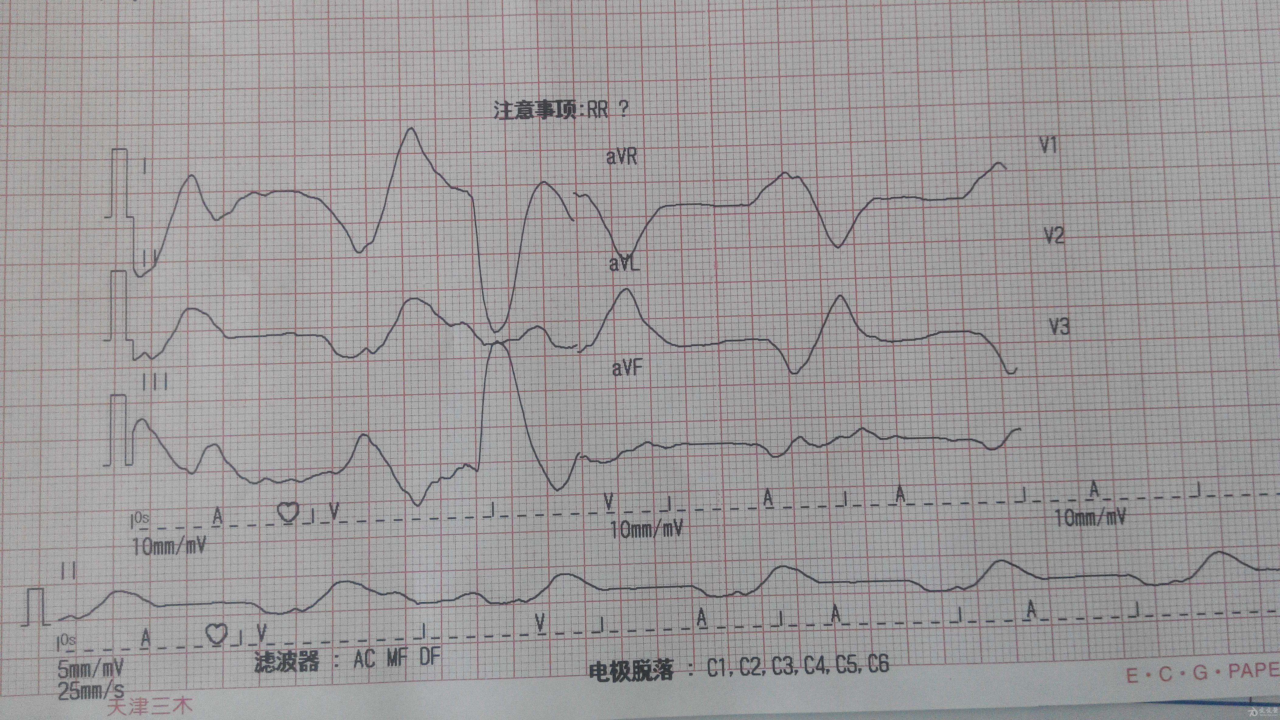 新生儿抢救心电图