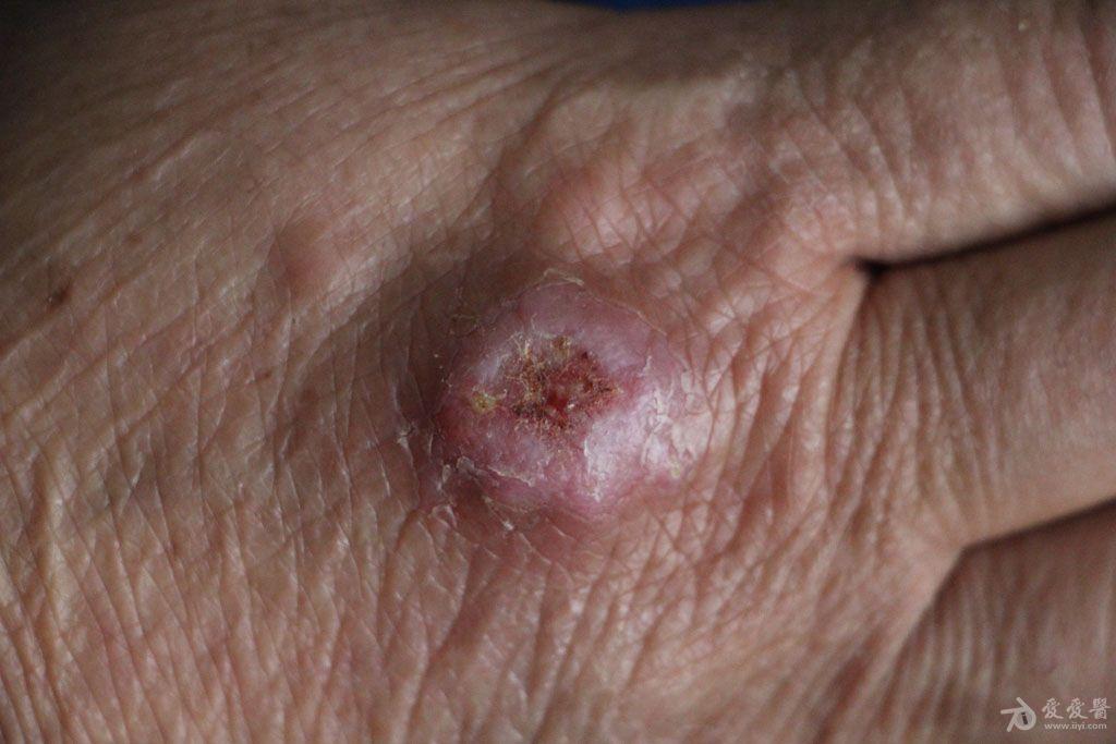 2016年皮肤版有奖病例猜答4答案孢子丝菌病