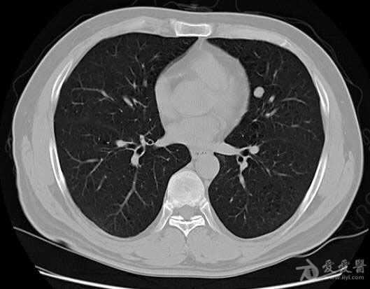 青年男性胸部结节ct检查