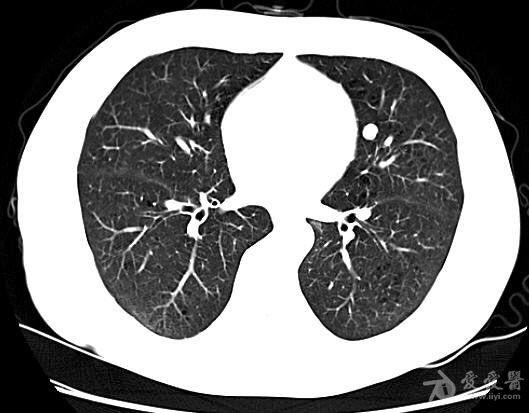 青年男性胸部结节ct检查
