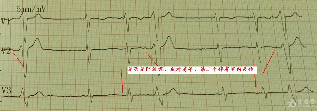 房性早搏三联律图片