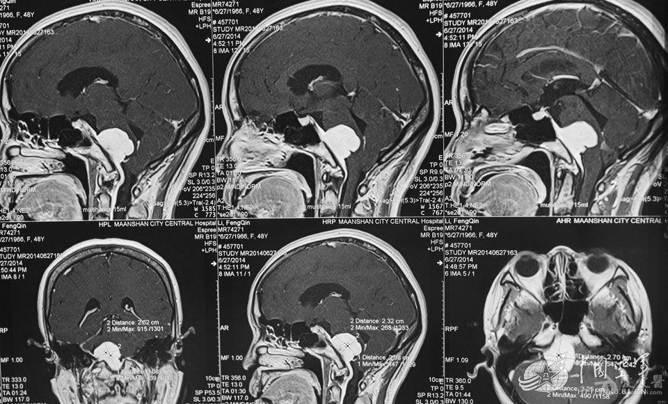 硬腭MRI图片