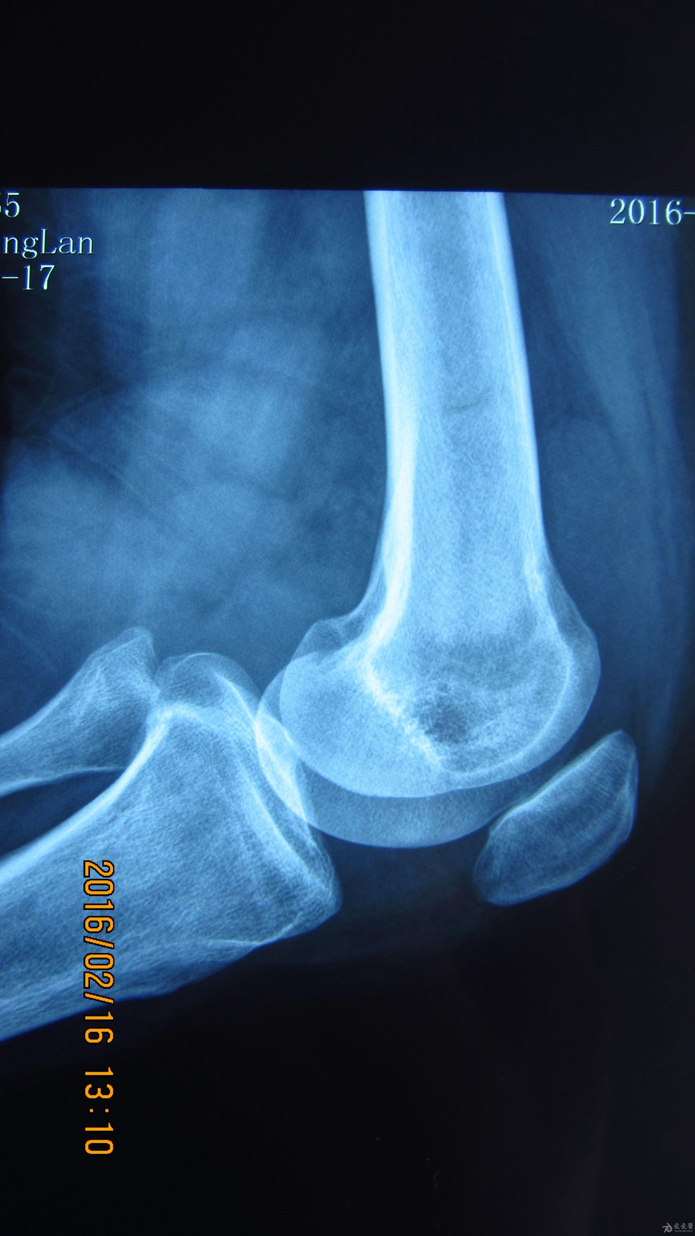 膝关节积液ct图片解析图片
