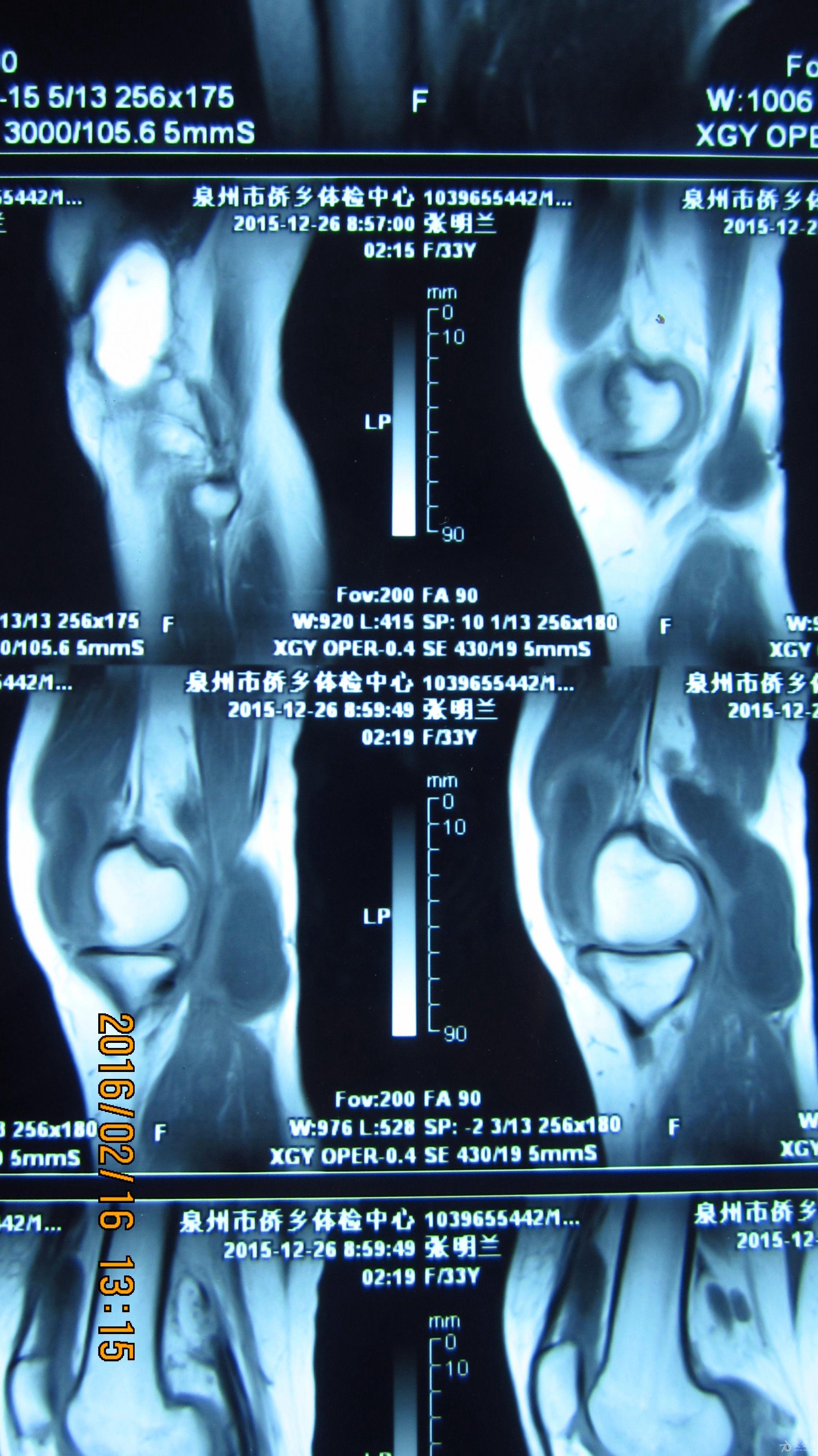 磁共振膝关节积液图片图片