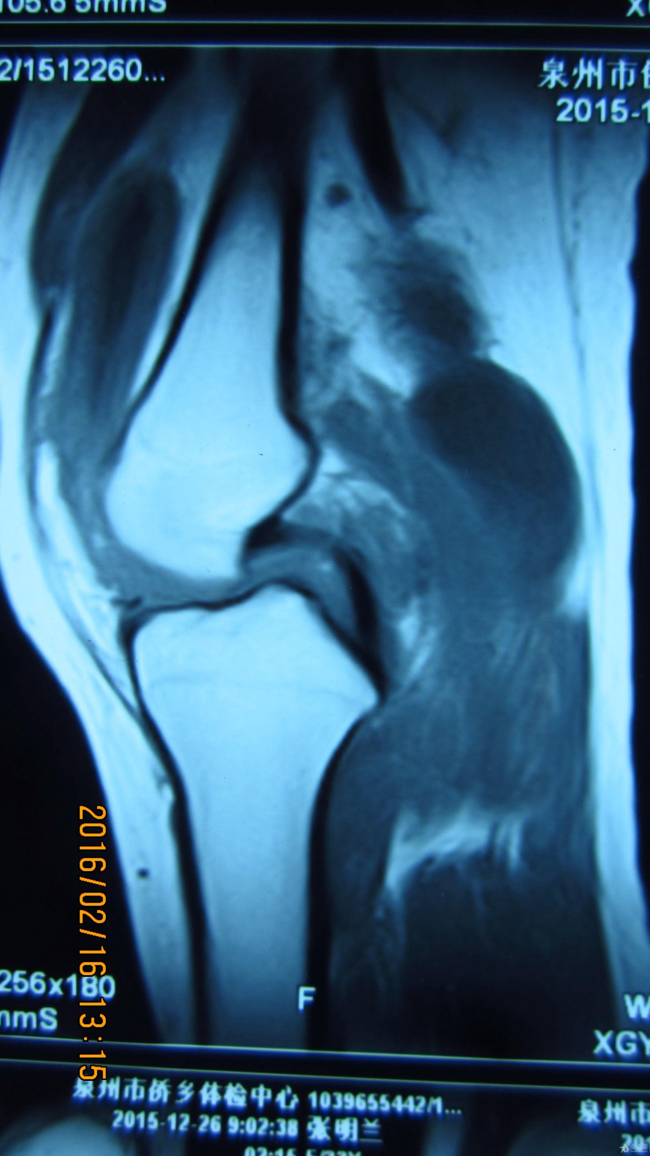 膝关节腔积液ct图像图片