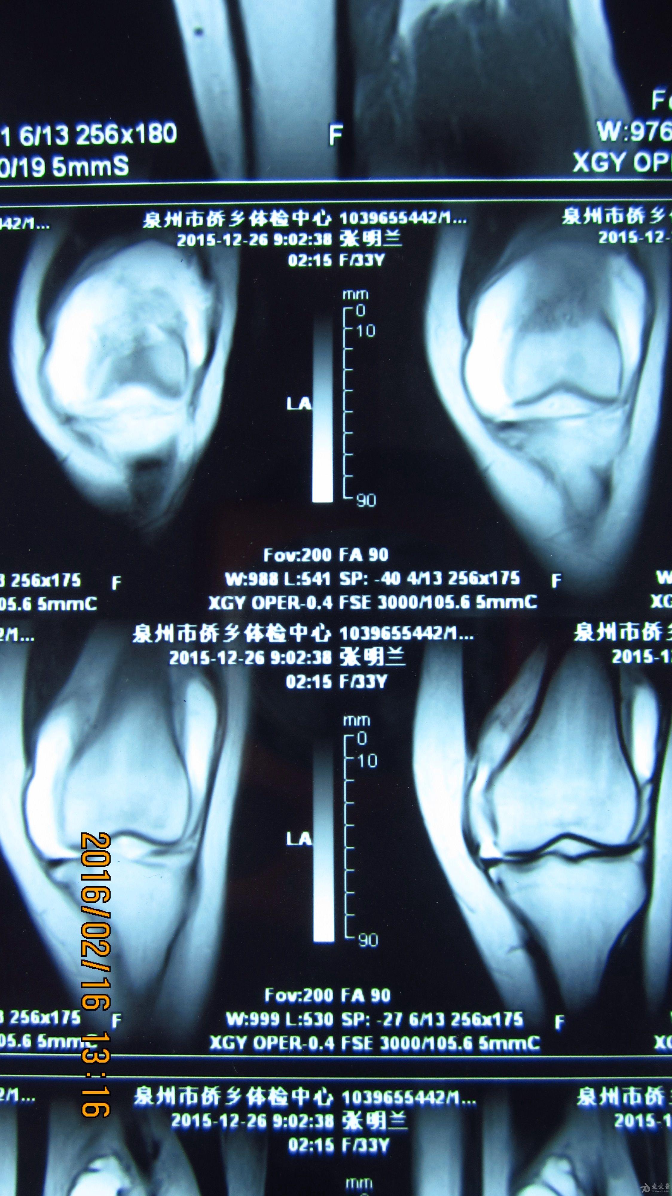 膝关节积液ct图片解析图片