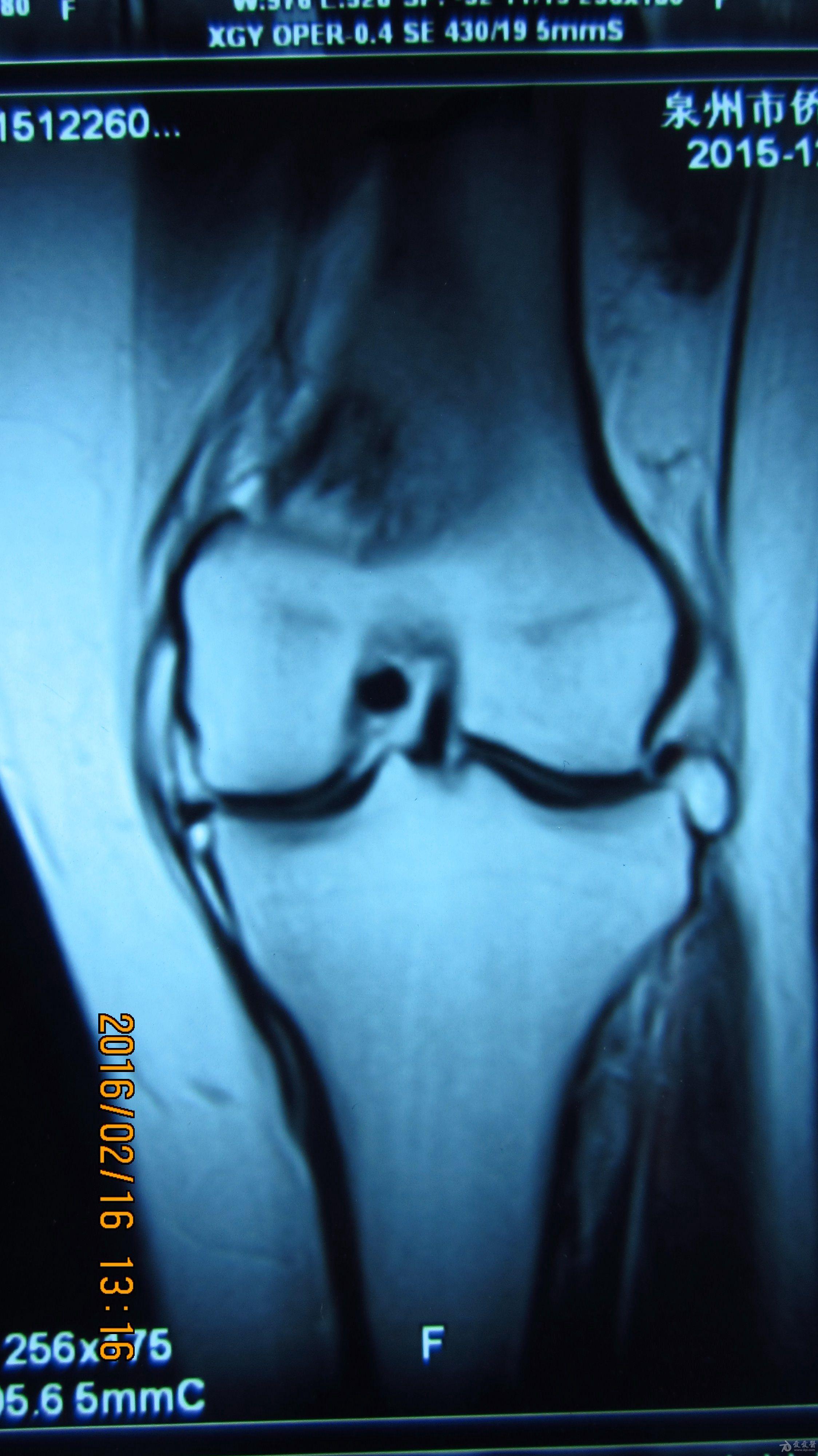 膝关节积液核磁图图片