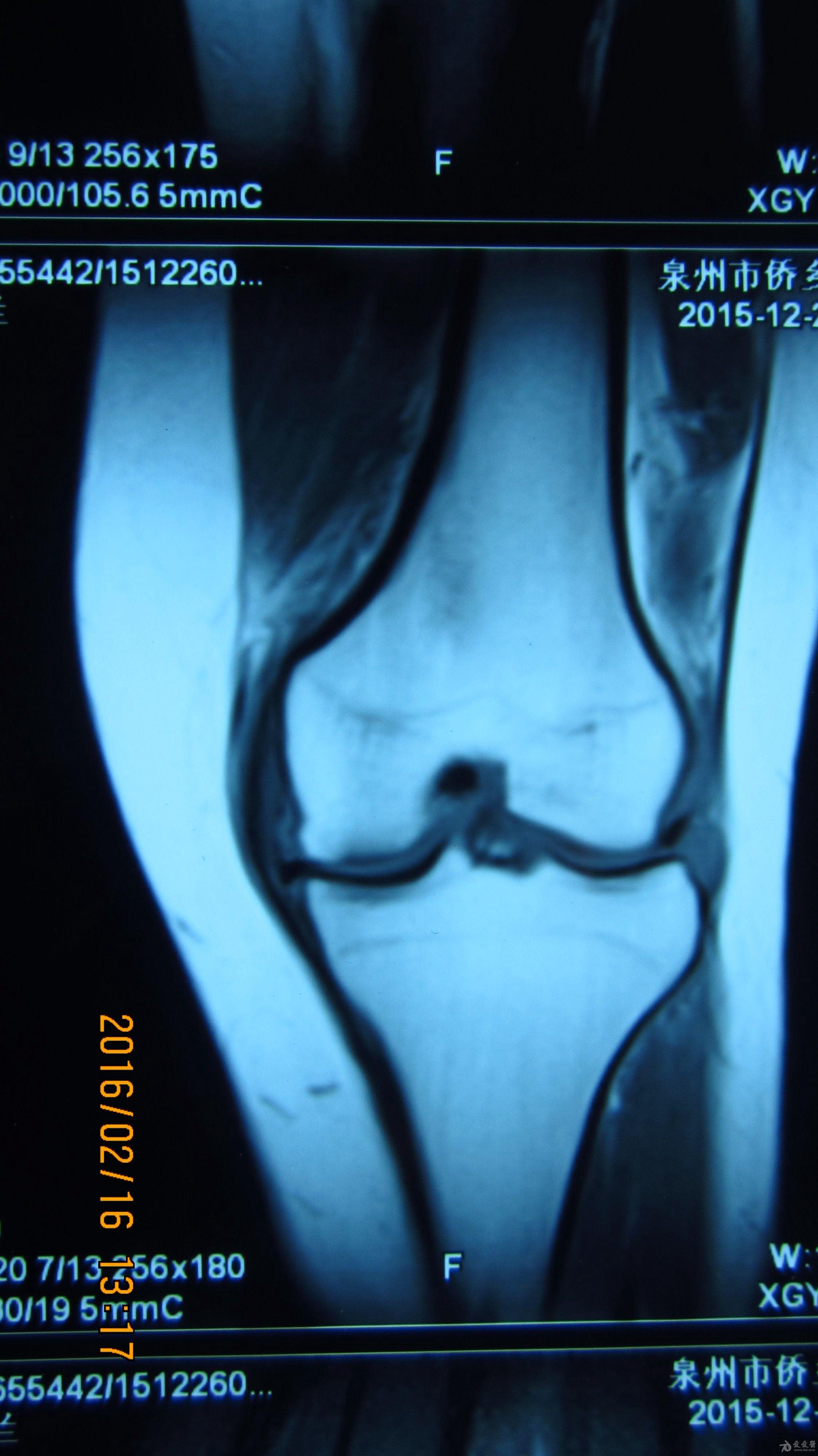 膝关节积液片子图片