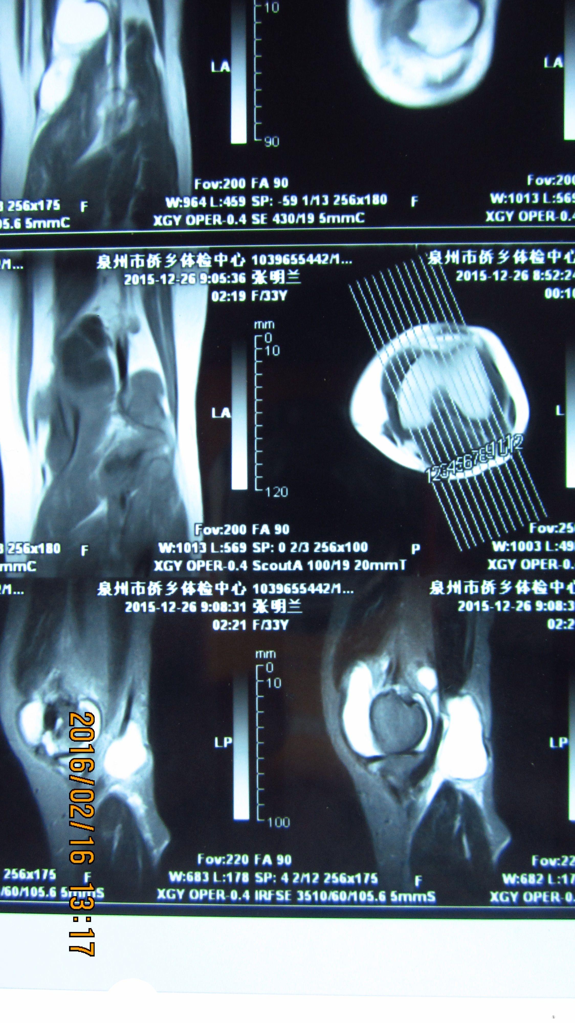 髌上囊积液ct影像图图片