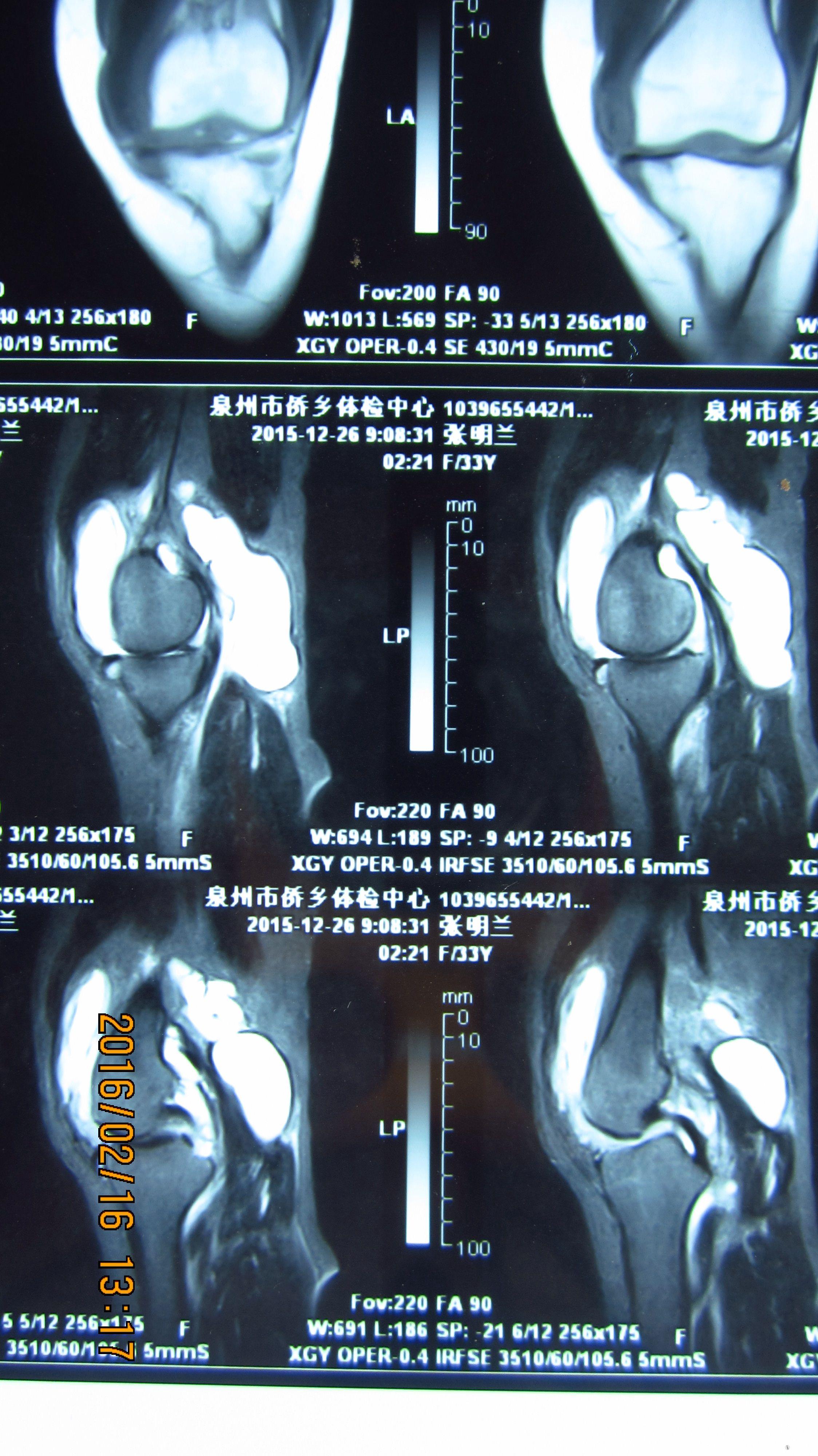 膝关节腔积液ct图像图片