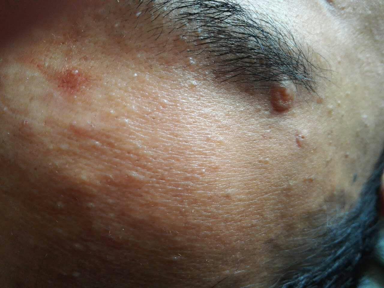 全脸散在皮色丘疹,类似闭合性粉刺,但没有内容物,右侧眉毛外侧有一