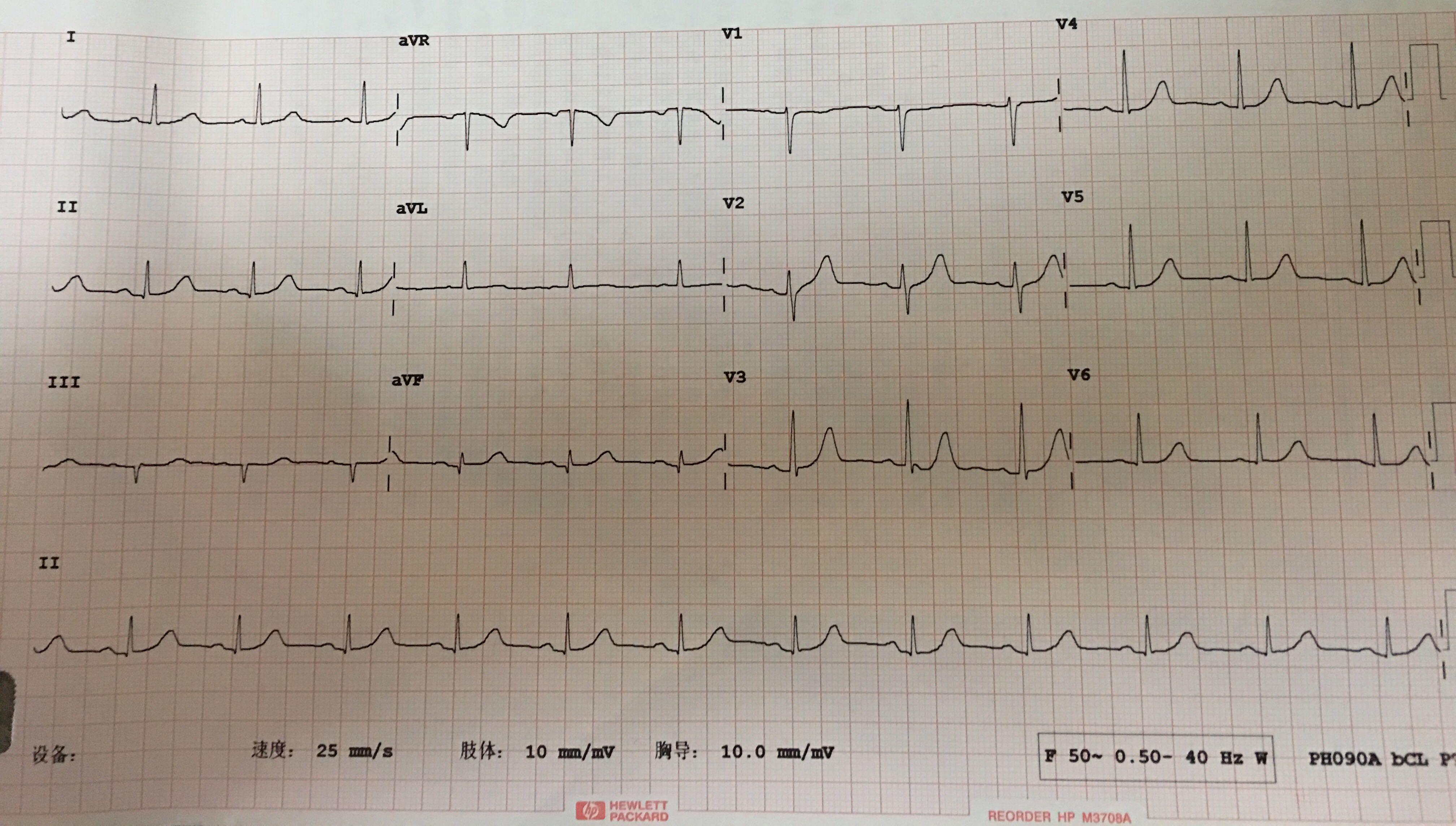 正常三导联心电图图片