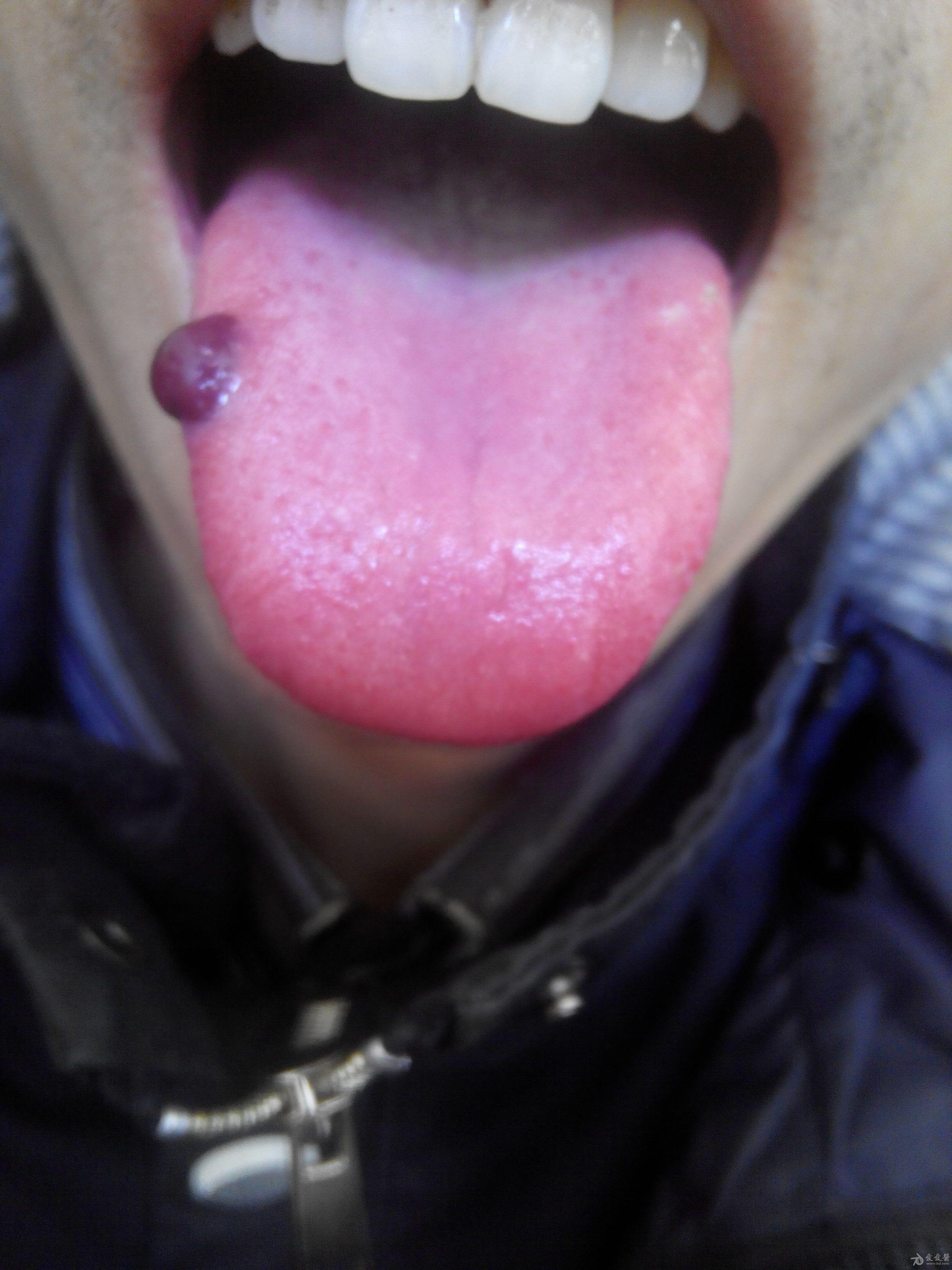 舌头上有小黑点图片图片