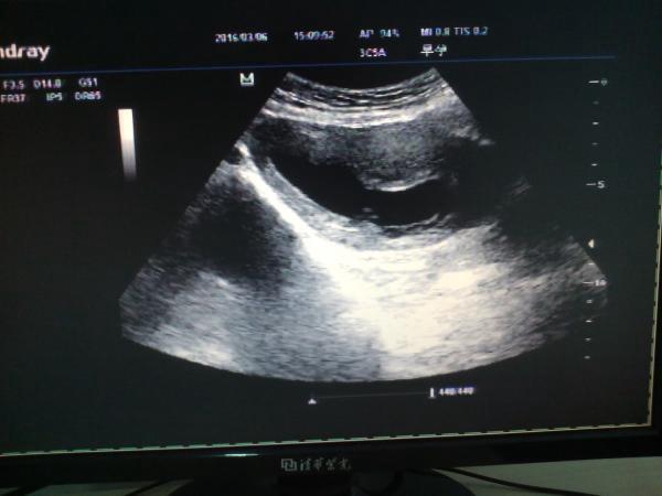CDFI:后壁见丰富得血流信号，胎盘？