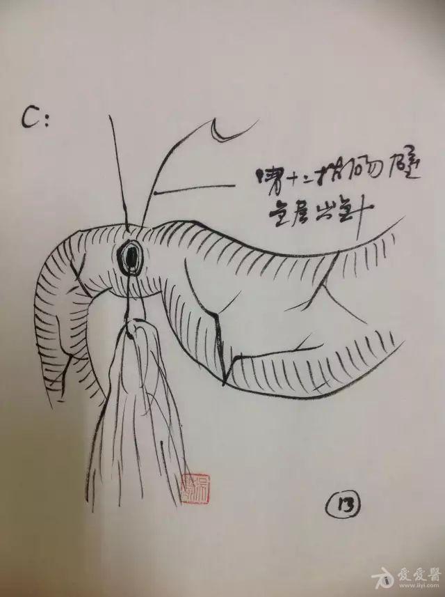 手绘图胃十二指肠穿孔修补术