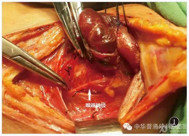 甲状腺全切除术中喉返神经损伤原因分析