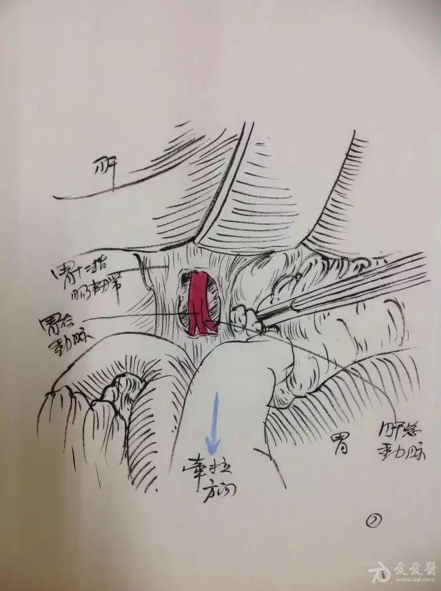 手繪圖分享:胃遠端大部切除術