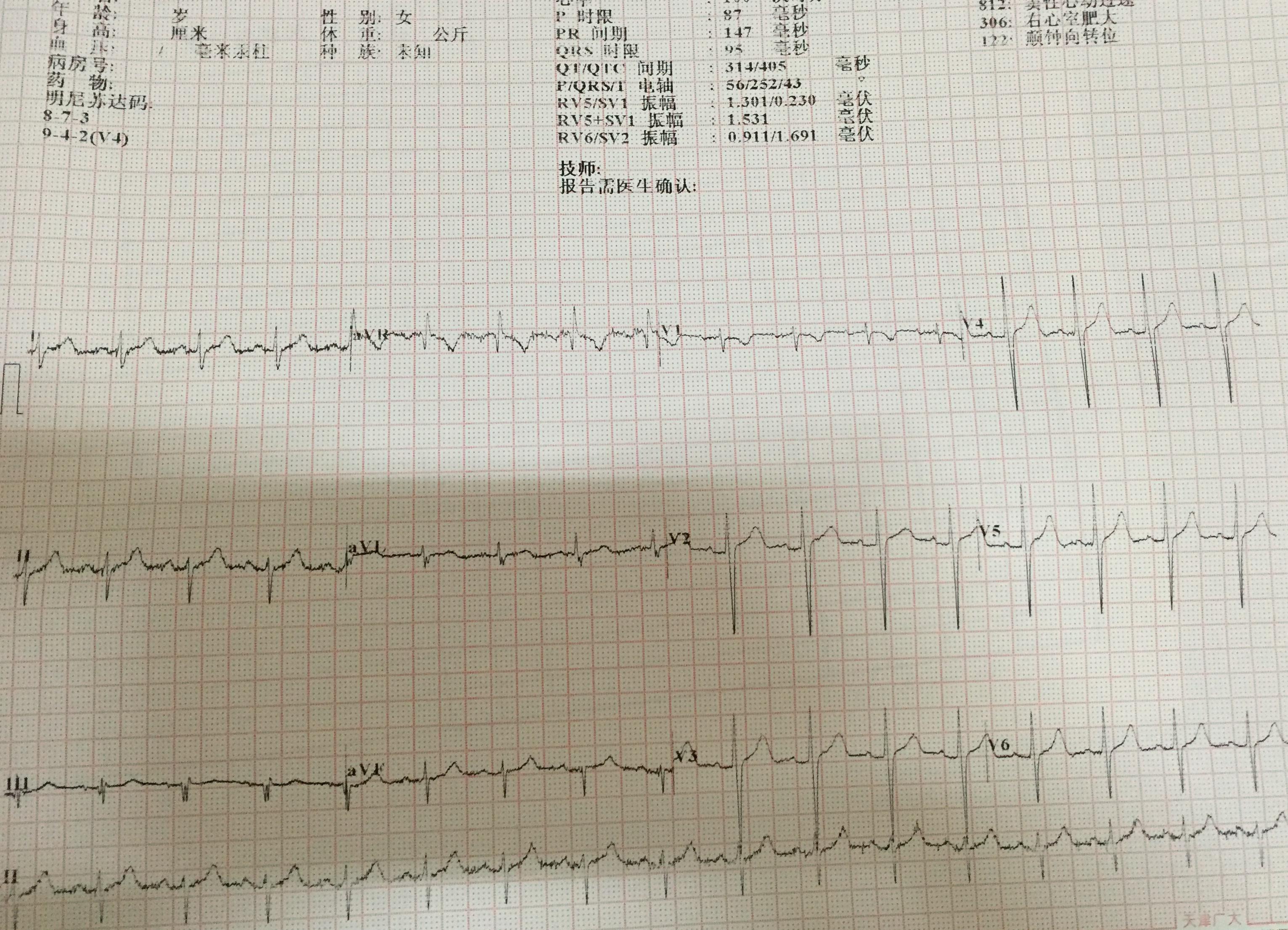 69 ★临床检查区 69 心电图脑电图专业讨论版 69 要考虑右心室