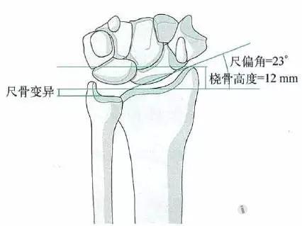 尺桡骨远端的应用解剖你还记得吗