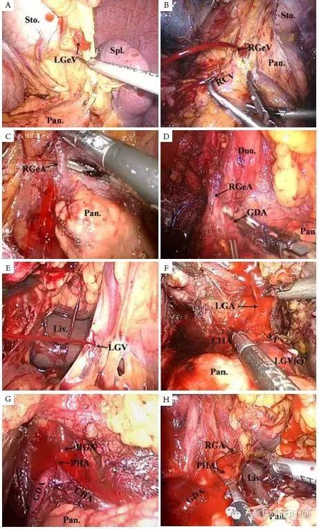 腹腔鏡遠端胃癌d2根治術術中常見的出血部位,原因和對策