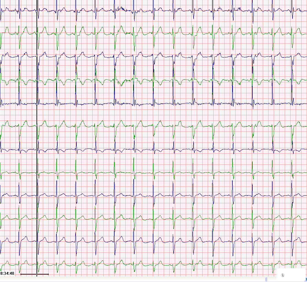 r波递增不良?右位心? - 心电图脑电图专业讨论版 - 爱爱医医学论坛