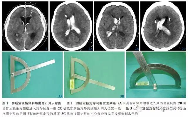 侧脑室额角穿刺角度的公式推导及验证