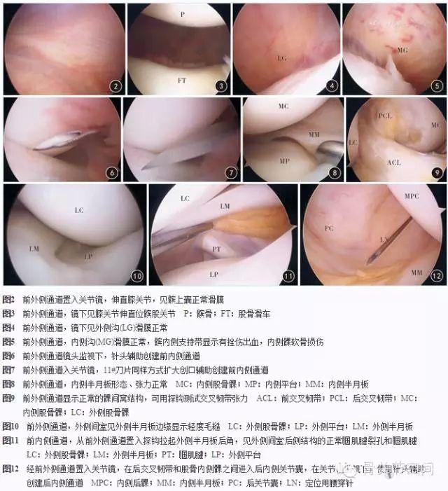 膝關節鏡手術入路的技巧及相關解剖