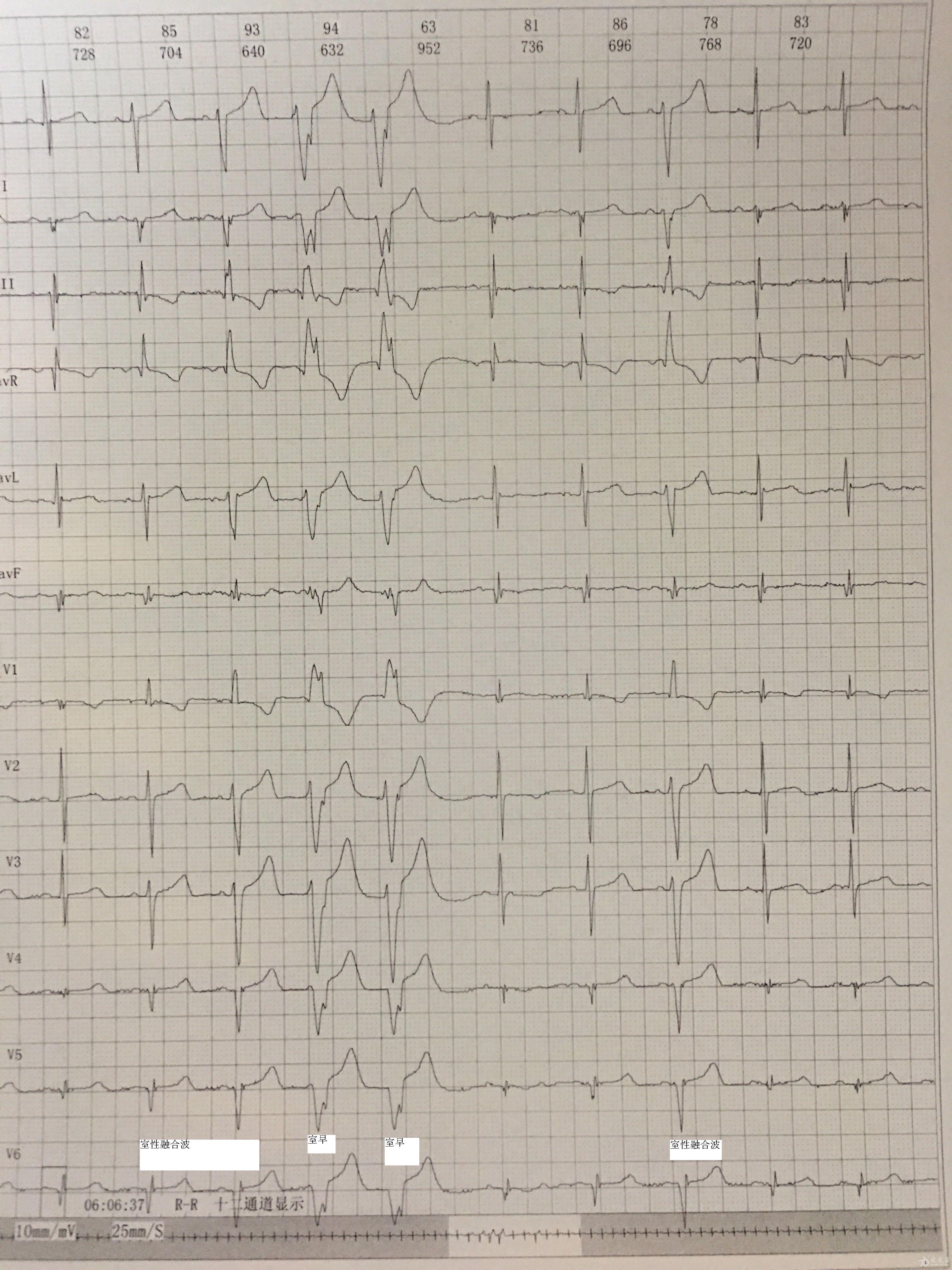 室性自主心律心电图图片