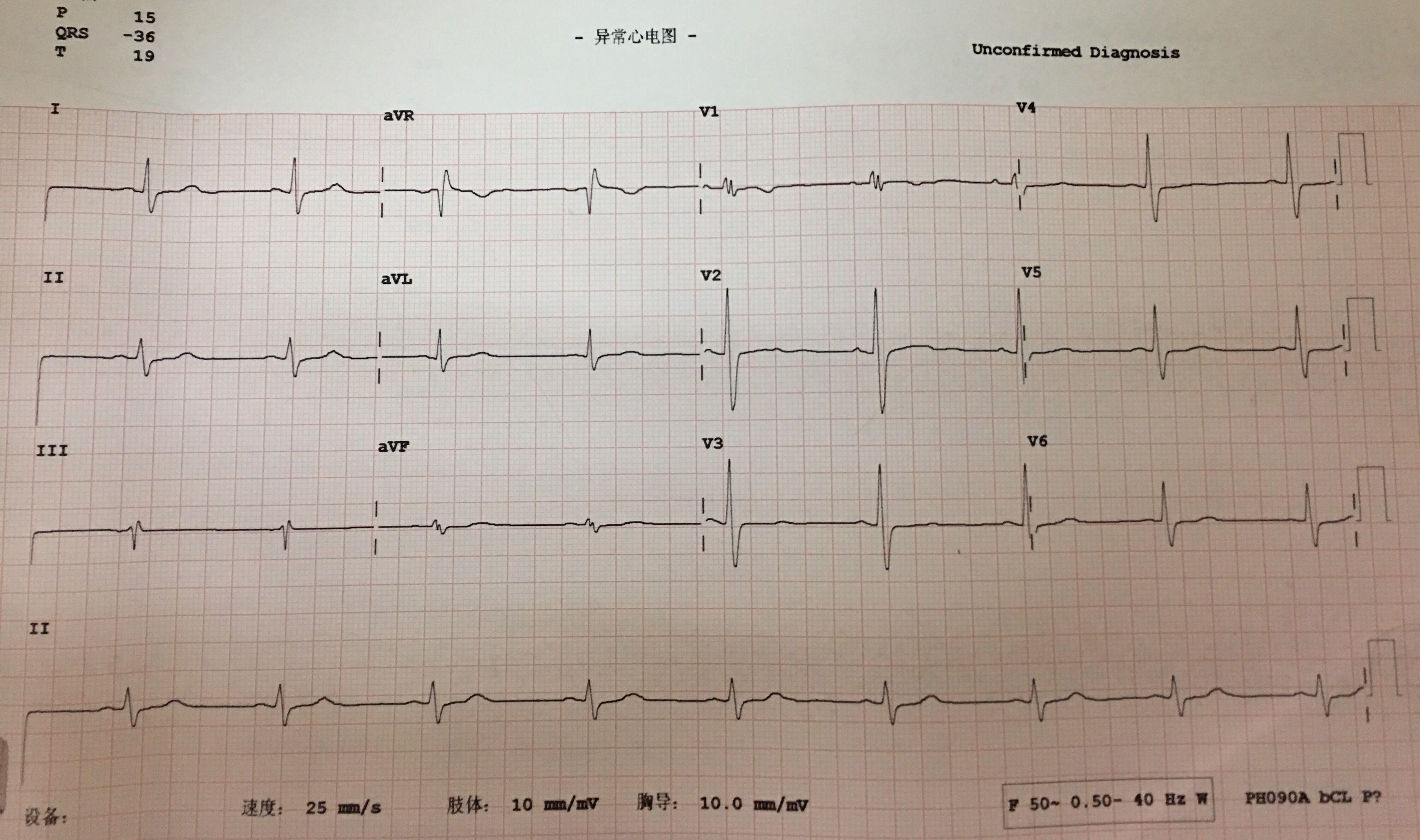 非特异性室内传导延迟? - 心电图脑电图专业讨论版 - 爱爱医医学论坛