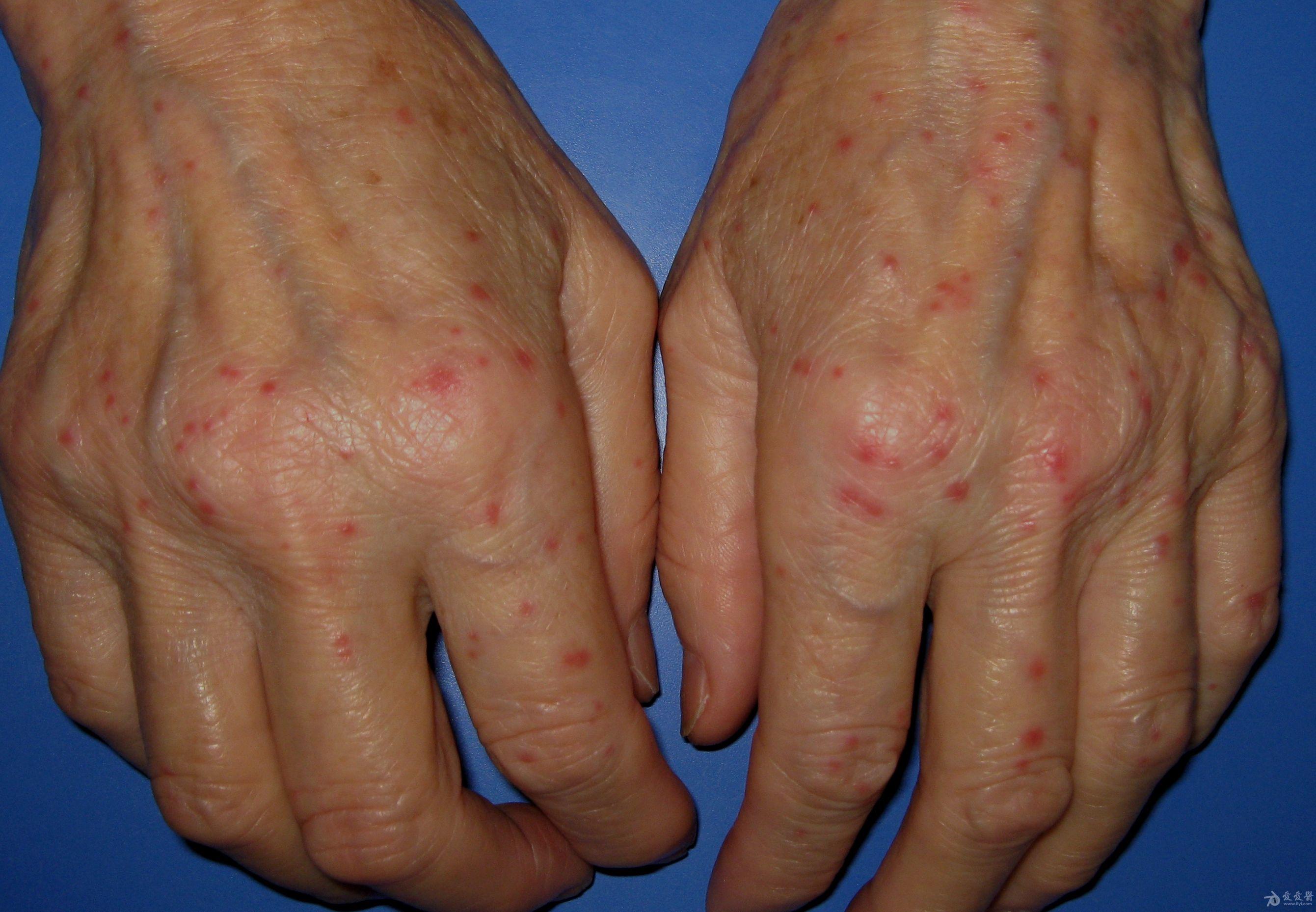 常见手部皮肤病8例