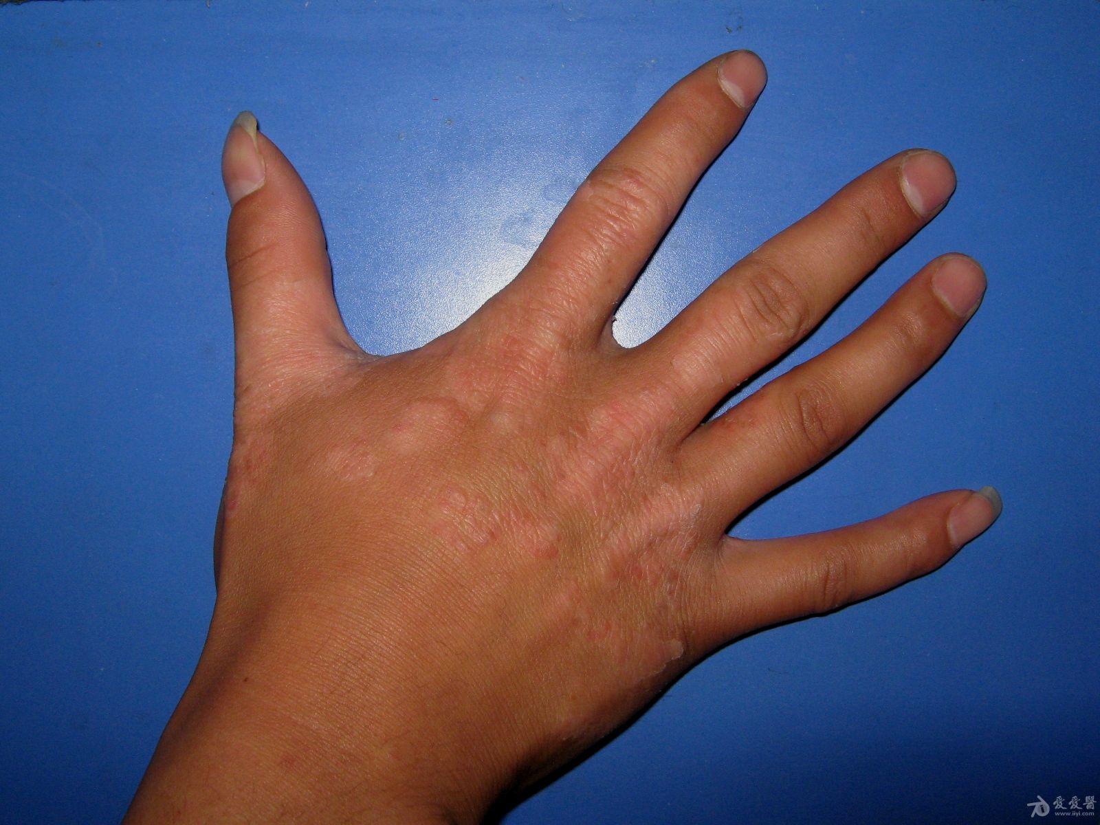 常见手部皮肤病8例
