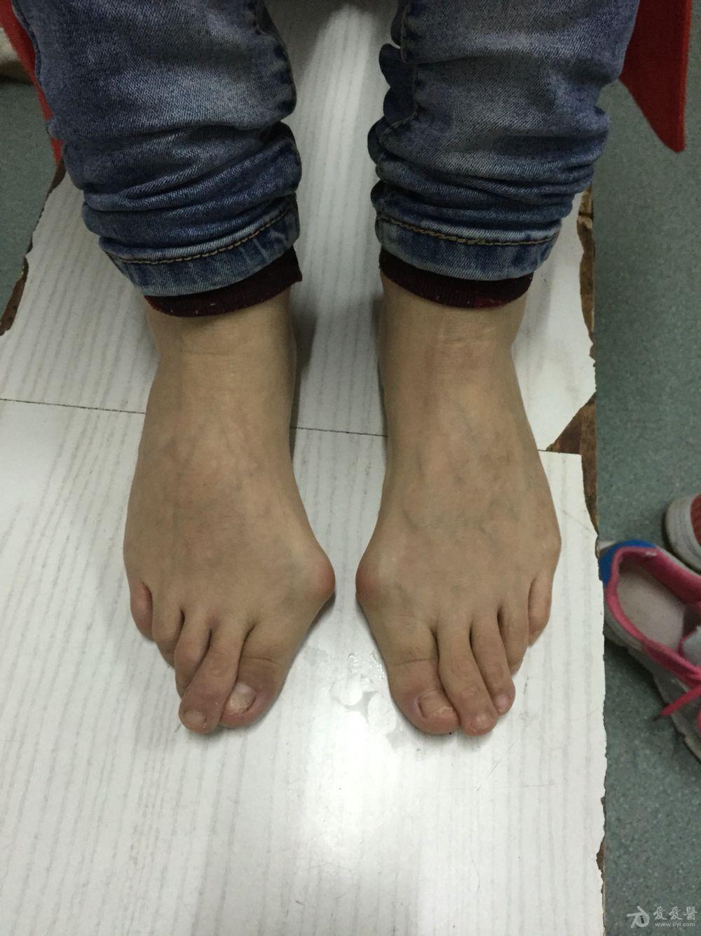 重度拇外翻求手术方案