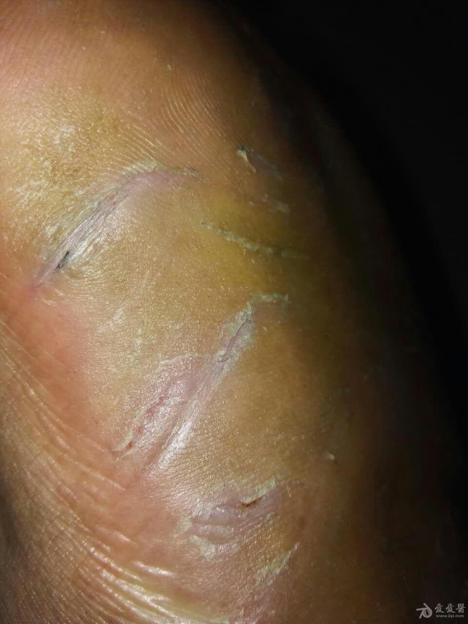 脚掌反复干裂