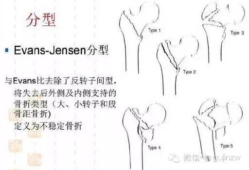 稳定?不稳定?股骨转子间骨折分型方法回顾