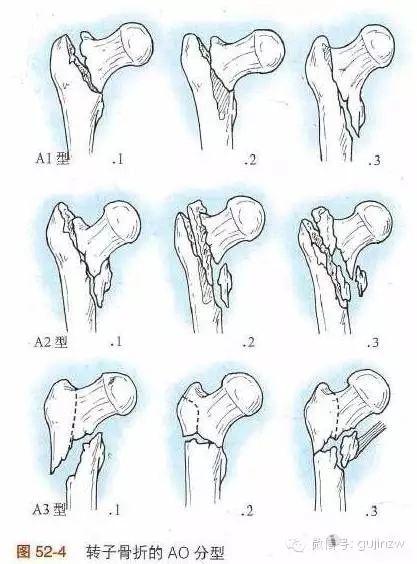 股骨骨折分类图片