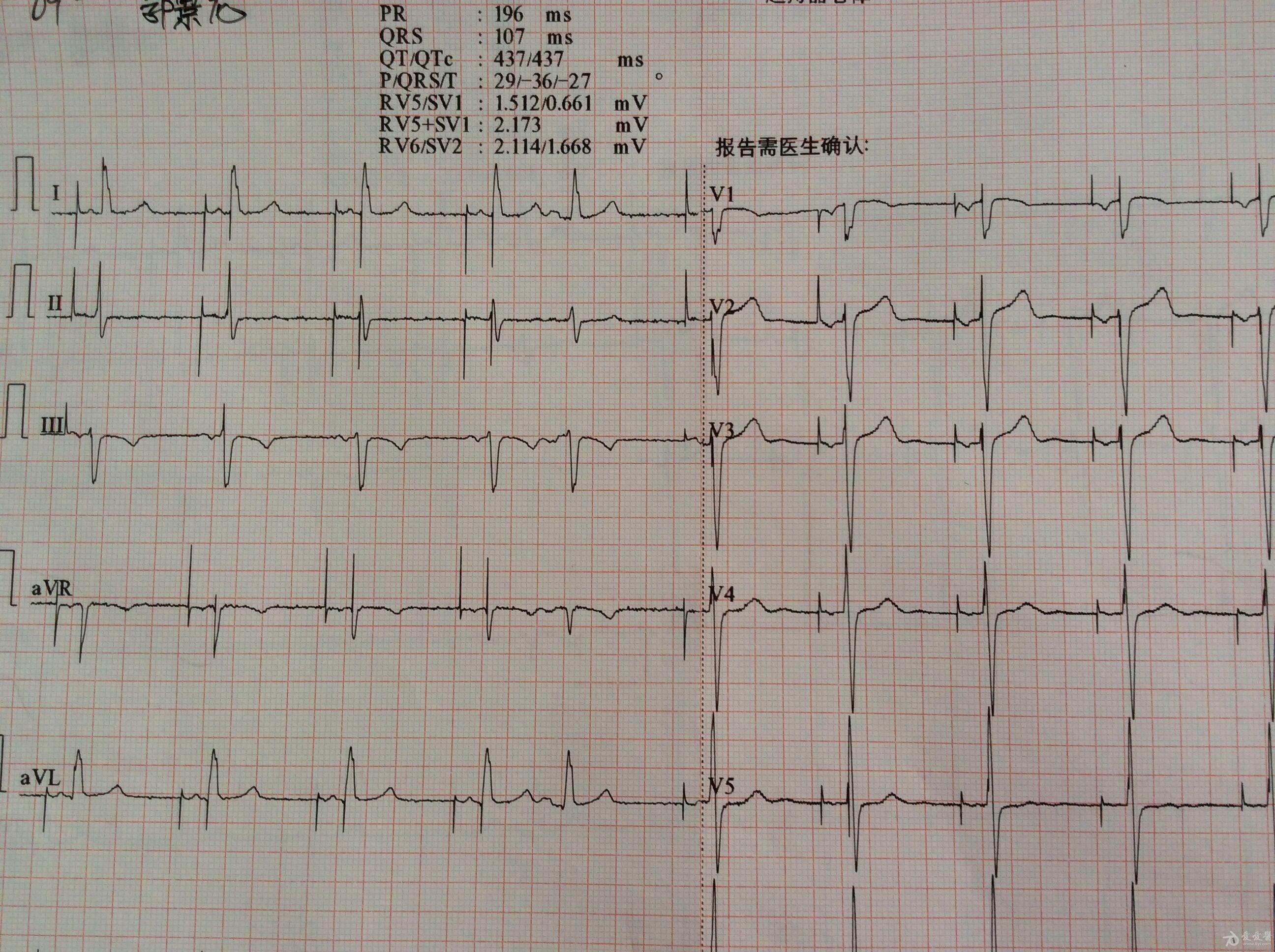 安装起搏器后心电图图片