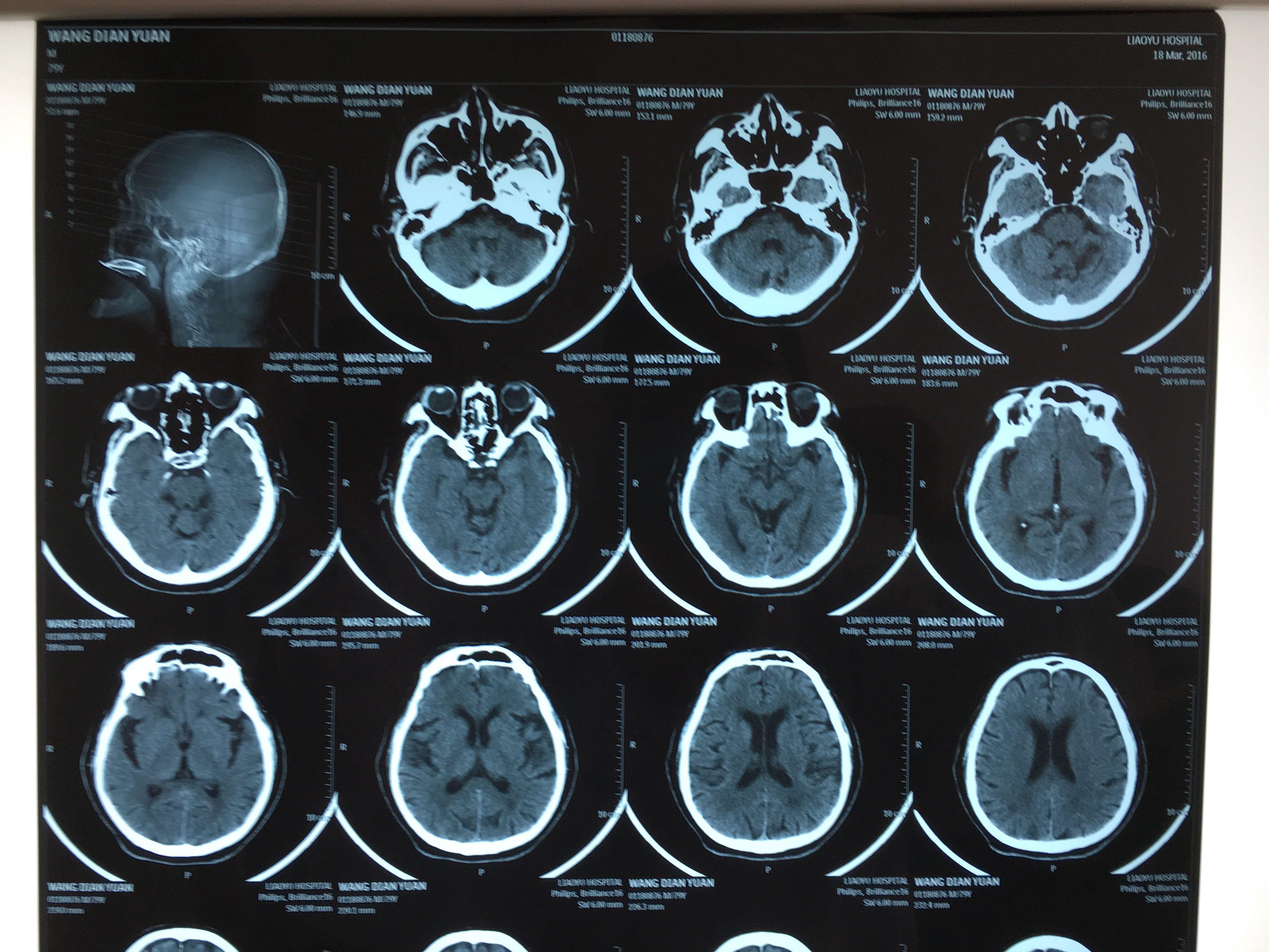 头晕乏力伴房颤的老年男性