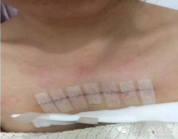 胸部疤痕疙瘩手术切缝放疗效果对比图