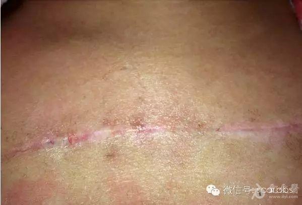 胸部疤痕疙瘩手术切缝放疗效果对比图