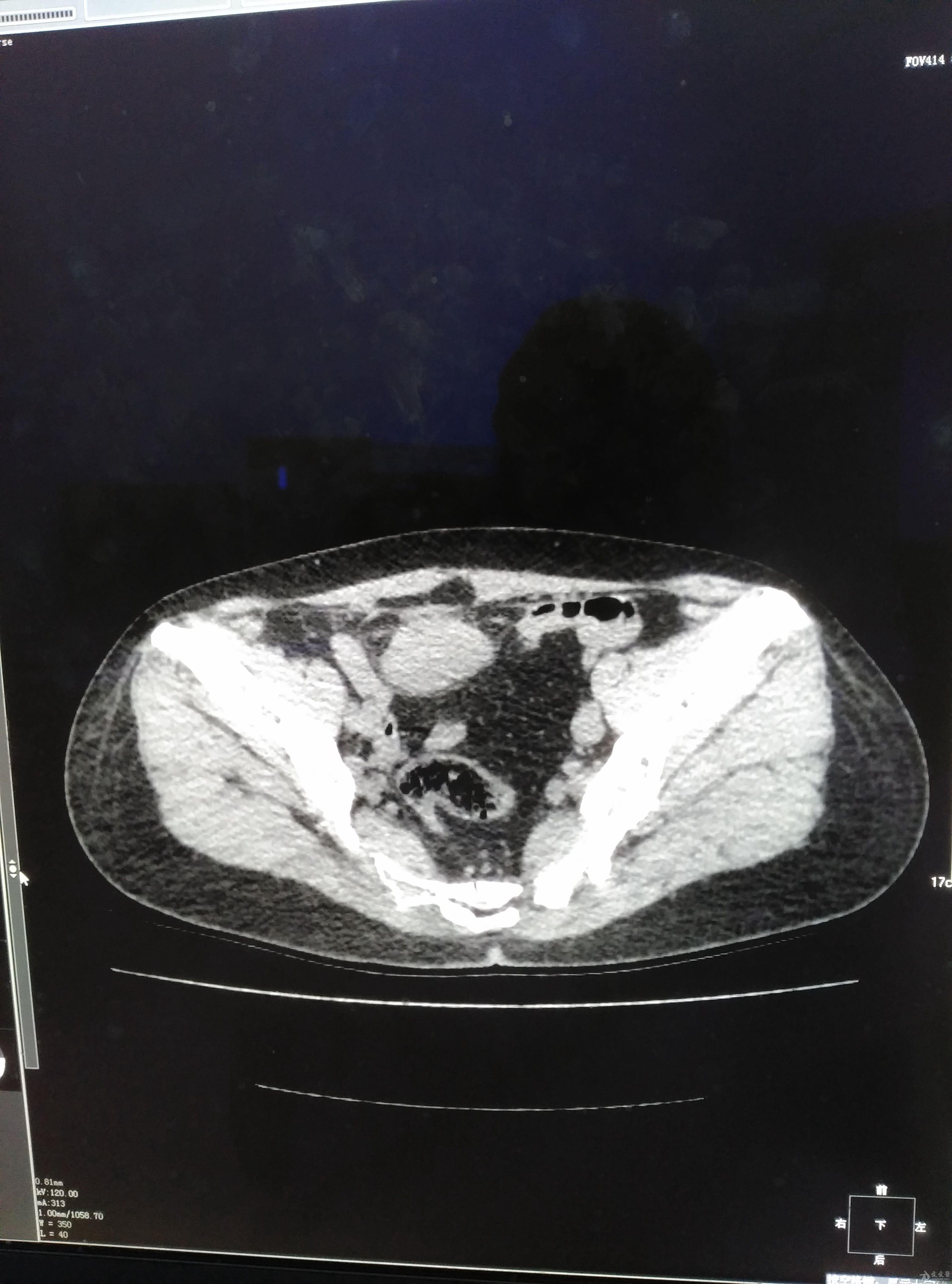 [腹盆] 腹部包块,女,53岁