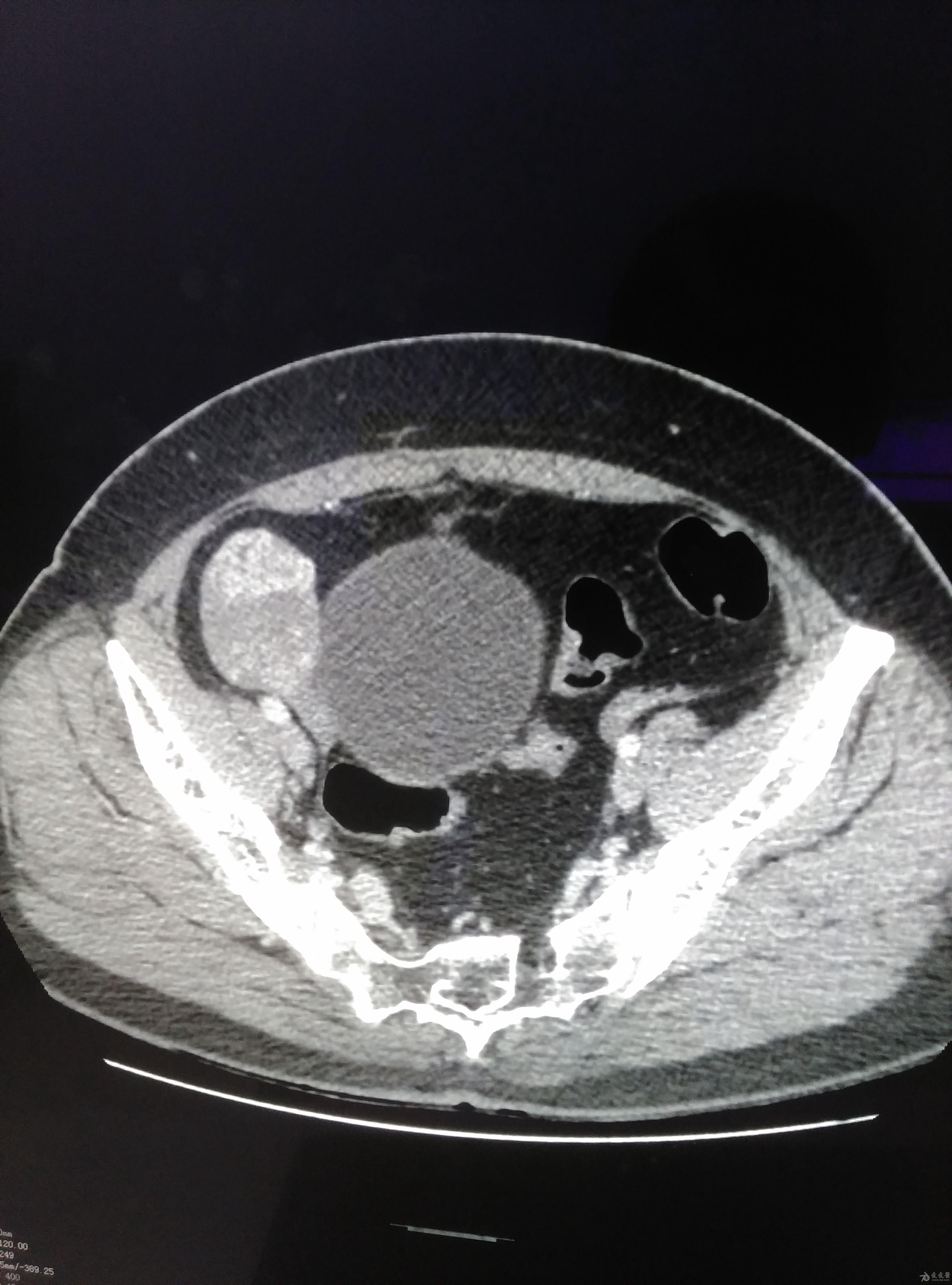 子宫平滑肌瘤CT图片