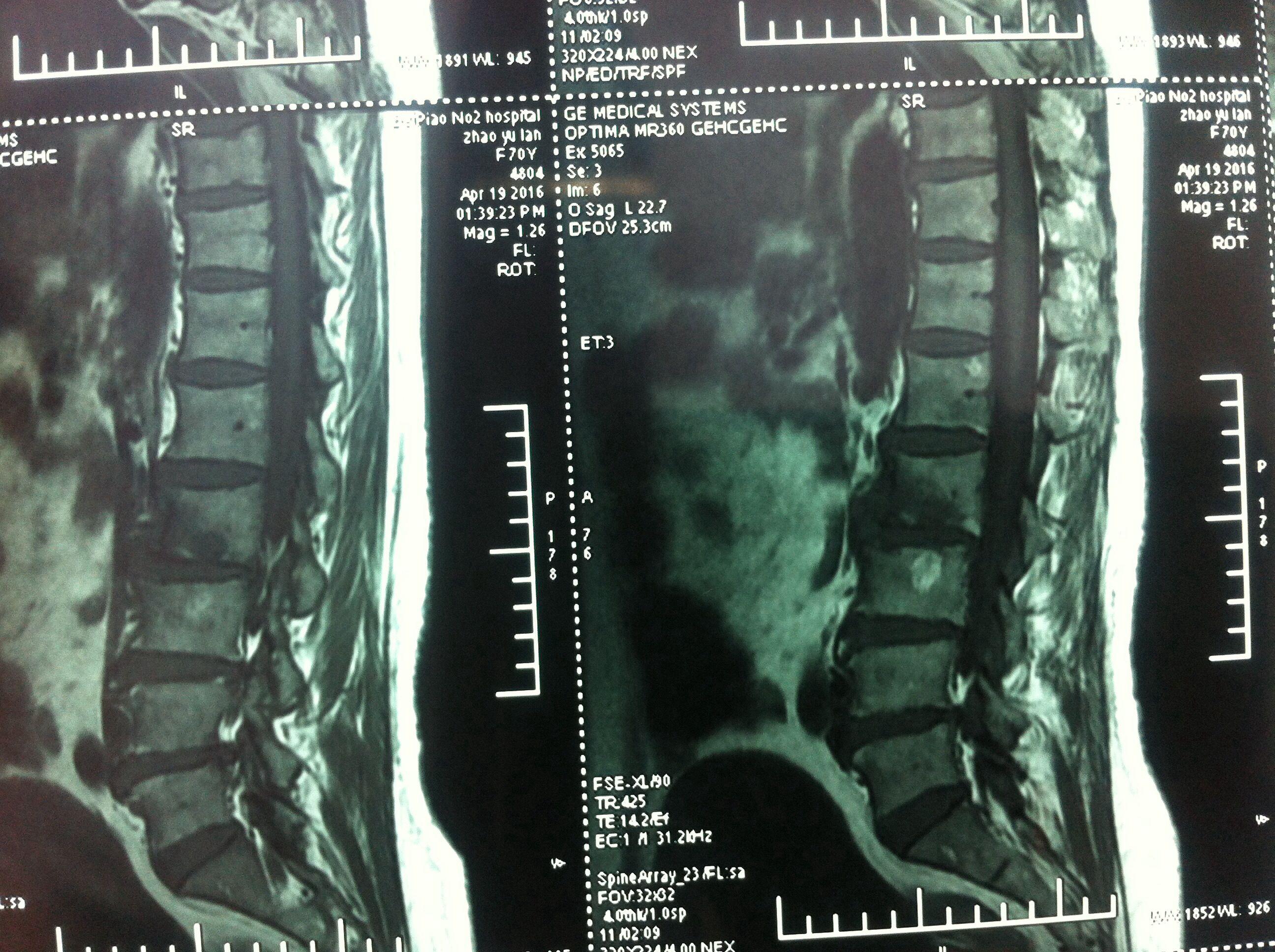 椎体病变,是结核还是肿瘤?