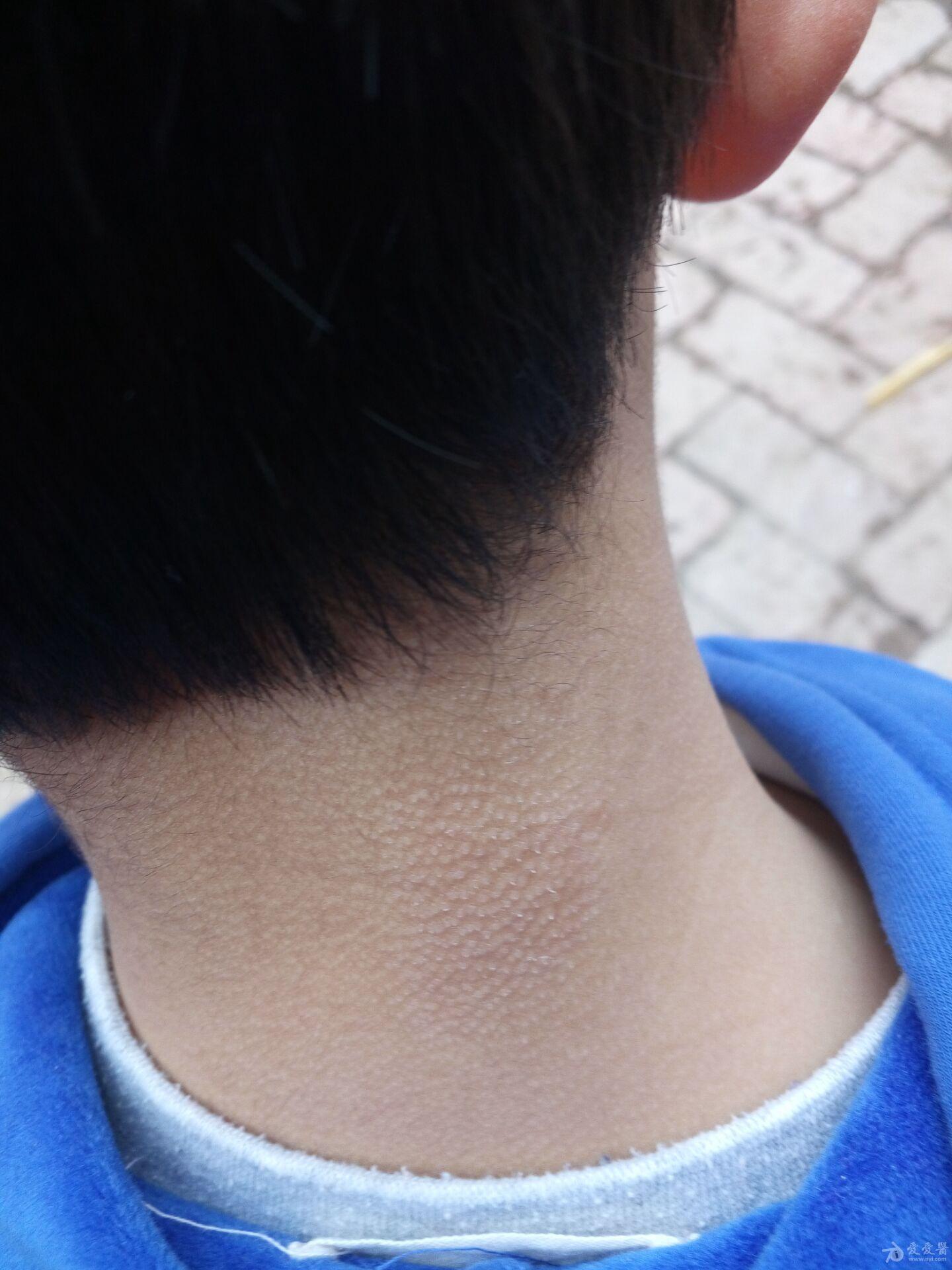 脖子上皮癣症状图片图片