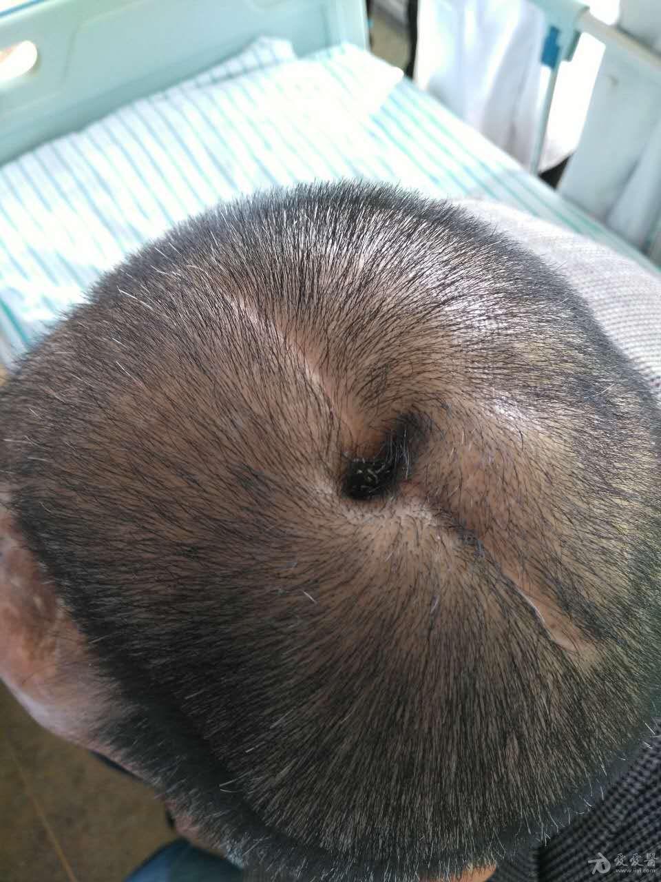 您遇到过头上长洞的患者吗原创