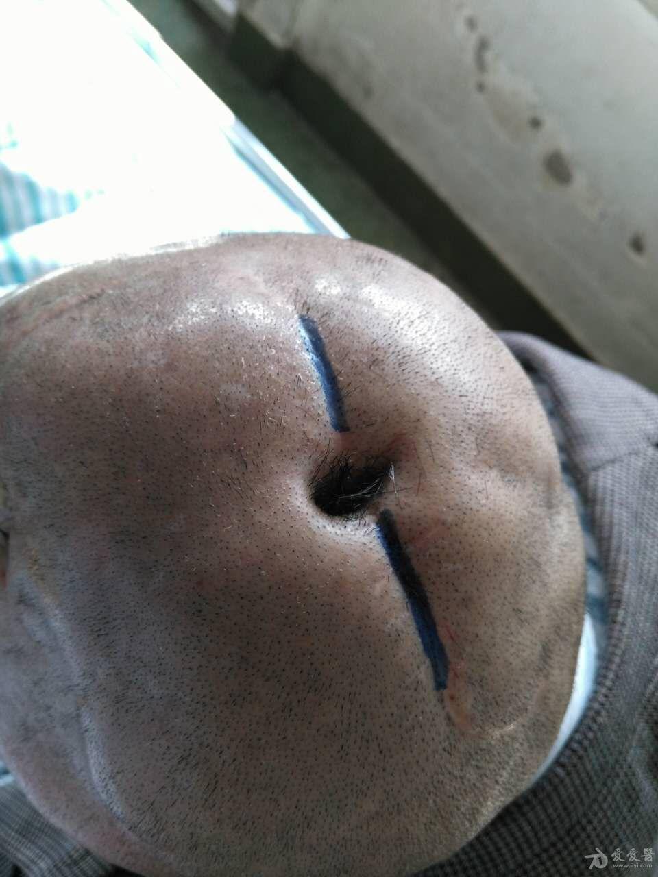 您遇到过头上长洞的患者吗原创