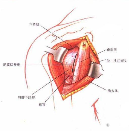 肱骨近端骨折---胸三角肌vs三角肌间入路,孰更优良?